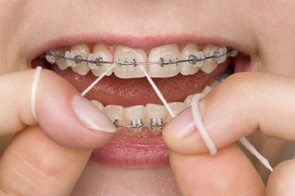 Oral hygiene during orthodontic treatment