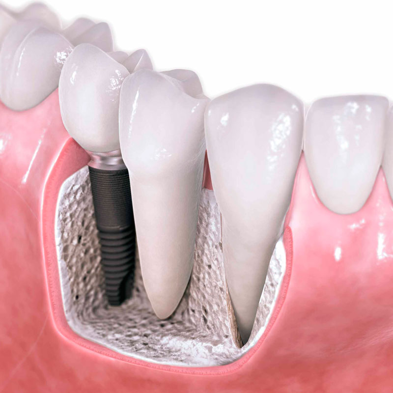 Немного об имплантологии 
