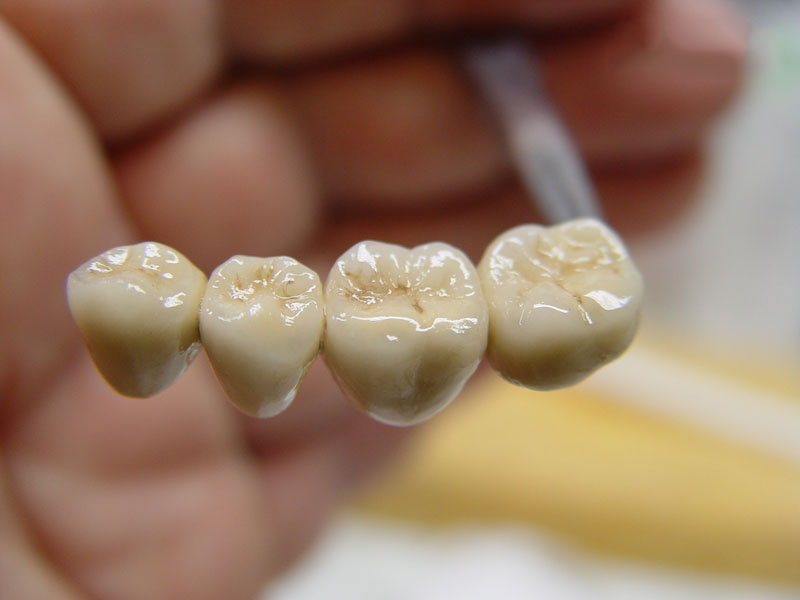 Metal-ceramic crowns