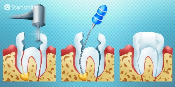 Treatment of pulpitis, periodontitis